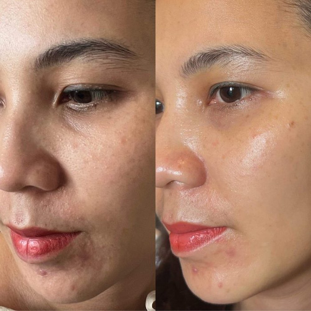 Kết quả trước sau