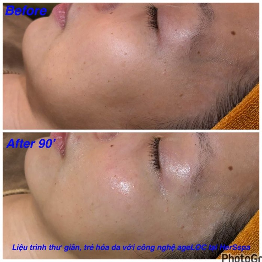 Kết quả trước sau