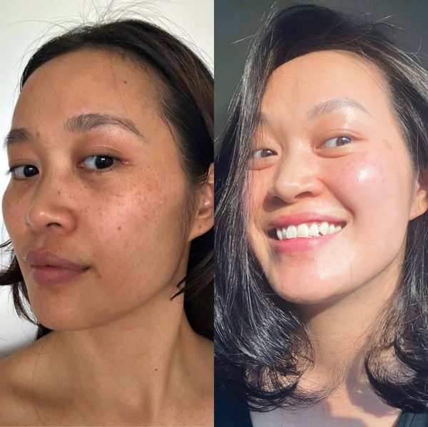 Kết quả trước sau