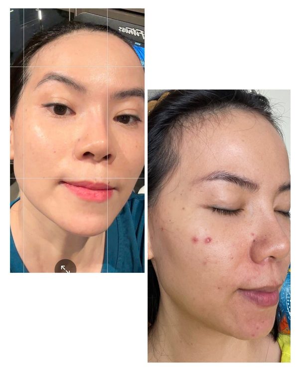 Kết quả trước sau
